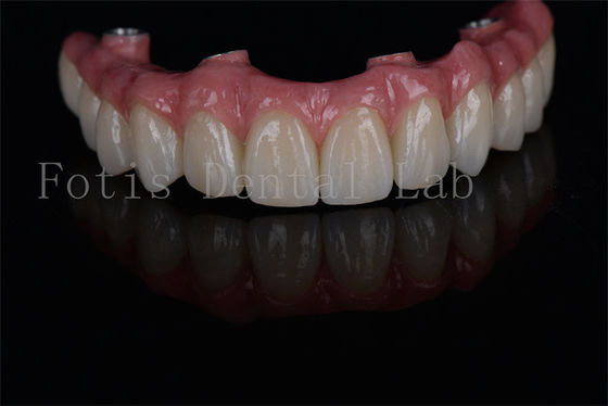 Uzun süreli 4'te 6'da tüm diş implantları Düşük kemik yoğunluğu ihtiyaçları için minimum invaziv ve kolay bakım