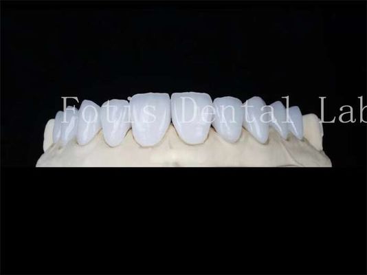 Özel Doğal Porselen Finerleri Diş Laboratuvarı Finerleri leke karşıtı