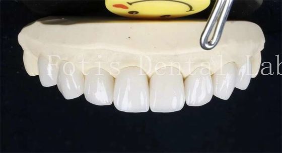 0.3-0.5mm Seramik Laminat Dişler Yapışkan Bağlama Çimento ile Sahte Dişler