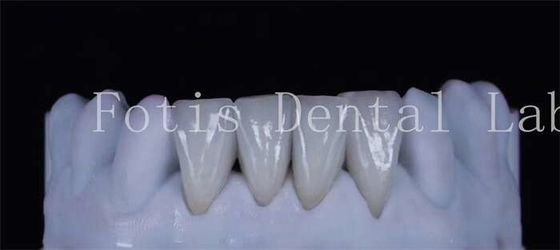İnce sentetik laminat kaplama dişleri 0.3-0.5 mm kalınlığı Güzel görünümlü