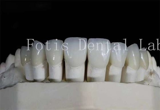 Doğal görünümlü gülümsemeler için yüksek şeffaflıklı cilalı diş laminatı kaplamaları