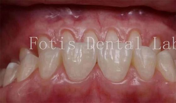 0.3-0.5mm Kalınlığı Kozmetik Dişler Kozmetik Diş Hekimliği için Finerler