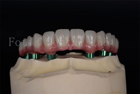 Uzun ömürlü Titanyum/Zirkonya Tüm 4/6 implantlar Kolay bakım Yüksek başarı oranı