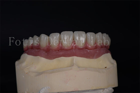 Doğal Estetik, 4'te 6'da 7 implant ile.