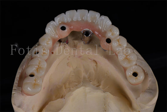 Başarılılık oranı: 4 kişilik tüm implantlar aynı gün prosedürü uygun fiyatlı tam çiğneme restorasyonu