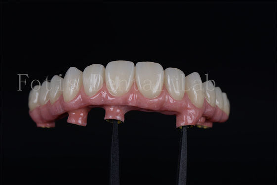 Doğal görünümlü, 4 veya 6 implantla tüm çiğnemek yeteneğini geri kazanmak