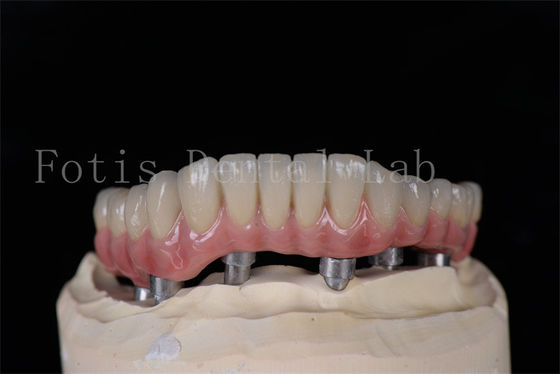 En az invaziv aynı gün 4'te 6'da tüm implantlar temizlenmesi kolay doğal görünüyor