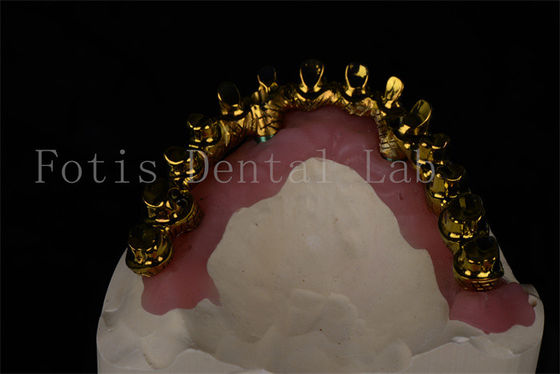 Doğal görünümlü tüm 4 tüm 6 Diş implantları tüm çiğnemek yeteneğini geri kazanır