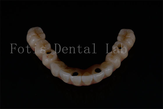 En iyi işlevsellik için tümü 4 ve tümü 6 ileri düzey diş implantı değiştirme
