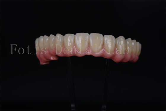 Tam kemerli implant köprüsü tümüyle 4 tümüyle 6 Tam diş restorasyonu için