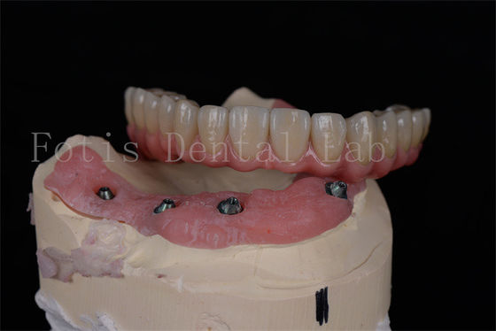 Tam bir ağız rehabilitasyonu için özelleştirilebilir tüm 4 ve tüm 6 diş implantları
