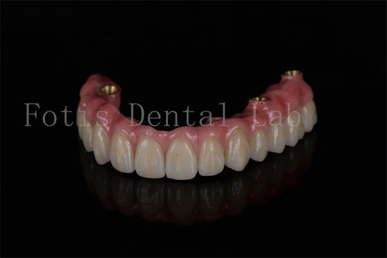 Dental implantların en iyi performansını sağlamak için tam kemer restorasyonu