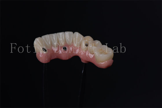 Bireysel All On 4 All On 6 Endosteal implantlar