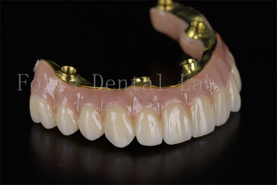 Tam Ağız Rekonstrüksiyonu 4'te 6'da tüm diş implantı sistemi