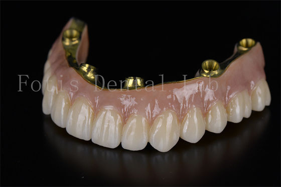 Tam kemer restorasyonu altı implant üzerinde en az invaziv çözüm.