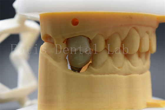 Kişiselleştirilebilir Diş İmplantı Abutment Taç Hastalar için Konforlu