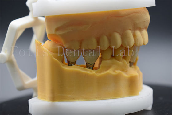 Diş implantı için hassas Titanyum Diş Tacı Temizlenmesi ve Bakımı Kolay