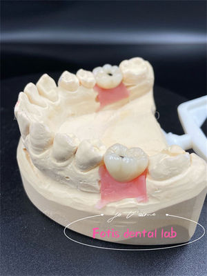 Özellik Titanyum/Zikonyum/PFM Diş Laboratuvarı Taçları Rahat