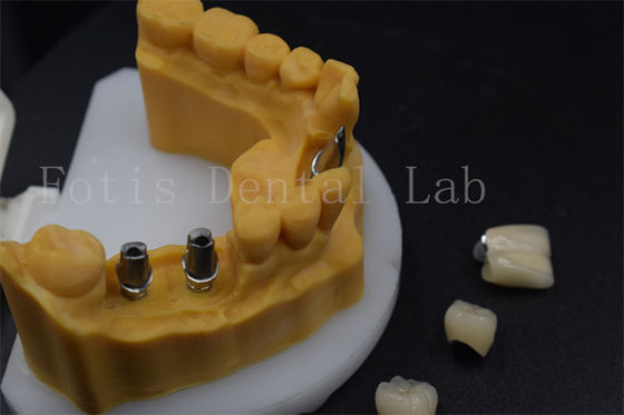 Yüksek Dayanıklılık Diş İmplantı Tacı Dental Implant Rehber Koltukları Düzenlemek Kolay