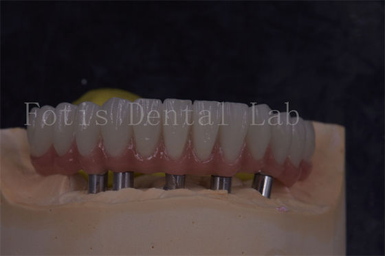 Doğal görünüm ve rahat restorasyonlar için özelleştirilebilir diş implantı taçları