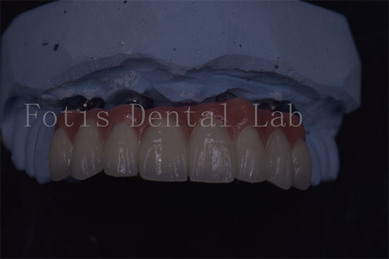 Uzun ömürlü ve konforlu olmak için hassas yapımı diş implantı taçları
