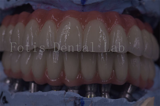 Üstün İşlevsellik İçin Gelişmiş Klinik Diş İmplantı Taçları