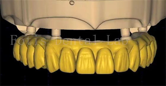 OEM Diş Tacı Tasarımı Gelişmiş Tarama ve 3B Baskı Teknolojisi Kullanıyor