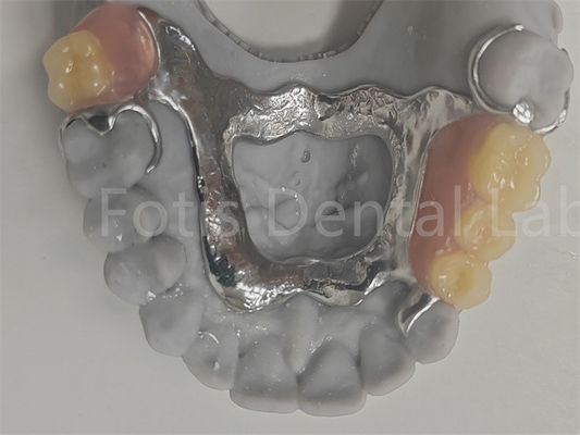 FDA Doğal Dişlerle Uyumlu Temizlenmesi Kolay Ayrılabilir Kısmi Diş Dişleri