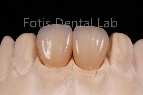Yüksek Şeffaflıklı Çok Katmanlı Dental Restorasyonların Üretimi İçin Zirkonya