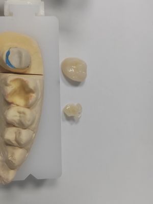 Uzun Sürekli Restorasyonlar Diş Eklentileri Onlay Üstün Güç ve Dayanıklılık