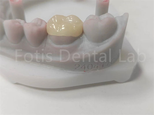 OEM Dental Inlay ve Onlay Seramik Restorasyon ve Diş Renkli Dolgu