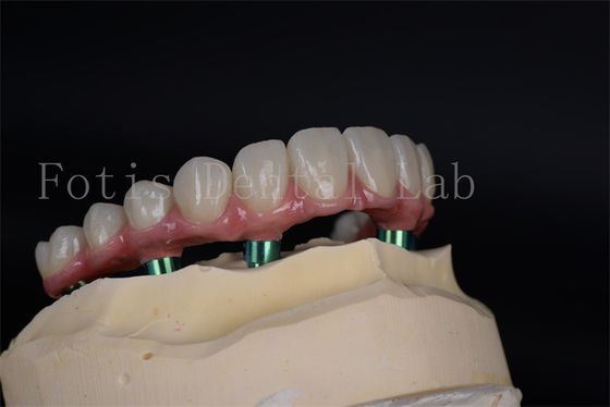 Düşük kemik yoğunluğu hastaları için gelişmiş tam çiğnemek yeteneğini geri kazanma implant prosedürü