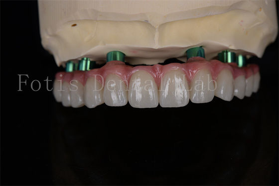Zirkonya All-on-4 implant prosedürü aynı gün iyileşme En az takip gereklidir